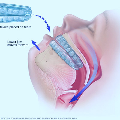 Obstructive sleep apnea - Diagnosis and treatment - Mayo Clinic